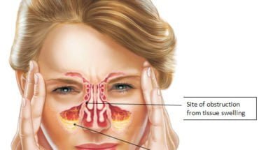 20 Cara Mengobati Penyakit Sinusitis