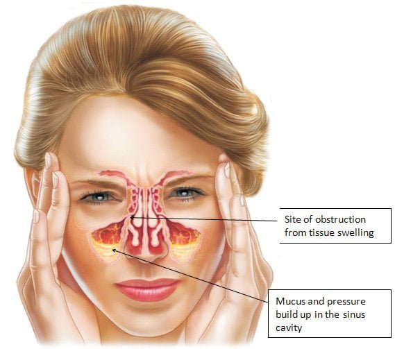 20 Cara Mengobati Penyakit Sinusitis